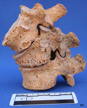 Three thoracic vertebrae fused together because of osteoarthritis. They are very porous. They are sitting on a blue table with a blue background. There is a small black and white ruler.